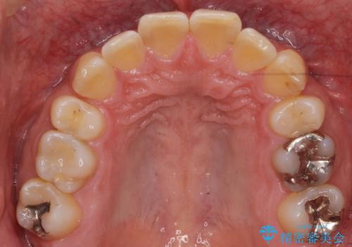 前歯だけ治したい インビザライン・ライト 30代男性の治療前