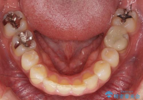 前歯だけ治したい インビザライン・ライト 30代男性の治療前