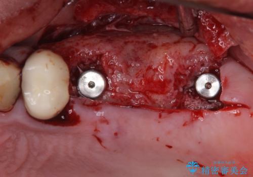 抜歯が必要な左右の奥歯 ブリッジとインプラントによる奥歯の補綴治療の治療前