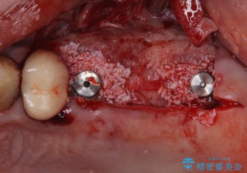 抜歯が必要な左右の奥歯 ブリッジとインプラントによる奥歯の補綴治療の治療中