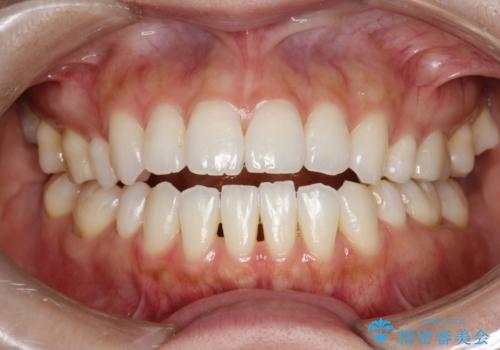 ホワイトニングで自然な白さにしたいの治療前