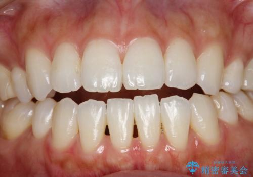 ホワイトニングで自然な白さにしたいの治療前