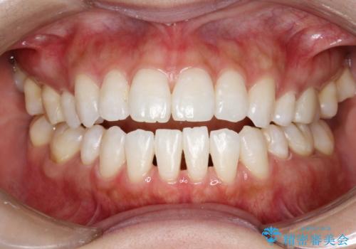 ホワイトニングで自然な白さにしたいの治療後