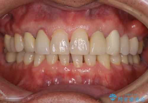 精密根管治療の開始前にPMTCの治療前