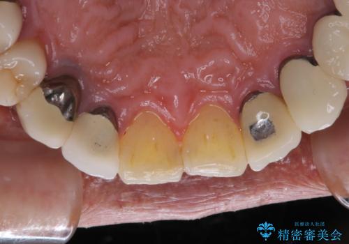 精密根管治療の開始前にPMTCの治療前