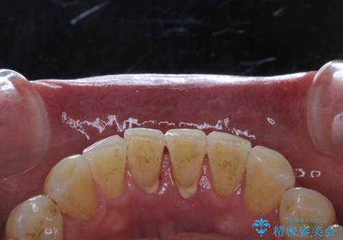 精密根管治療の開始前にPMTCの治療前