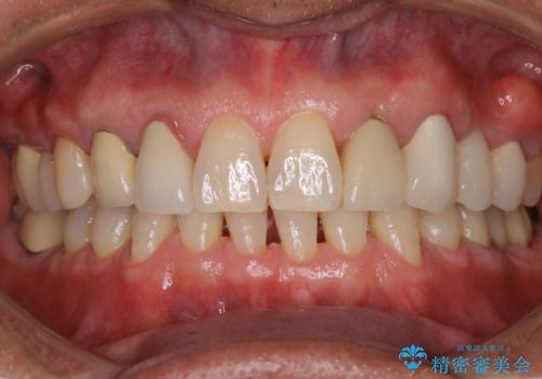 精密根管治療の開始前にPMTCの治療後