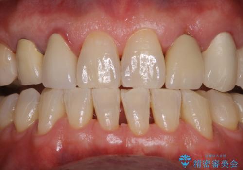 精密根管治療の開始前にPMTCの症例 治療後