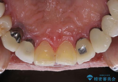 精密根管治療の開始前にPMTCの治療後