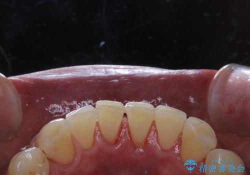 精密根管治療の開始前にPMTCの治療後