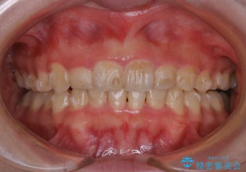 インビザライン中にステインの除去の症例 治療前