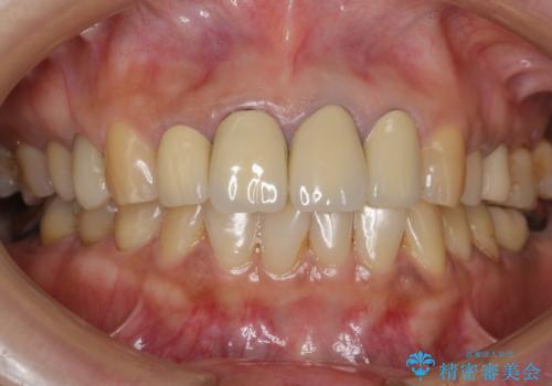 長持ちするセラミック 5年経過症例 50代女性の治療前