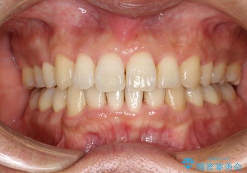 再矯正、後戻りを治したい、マウスピース矯正の治療後