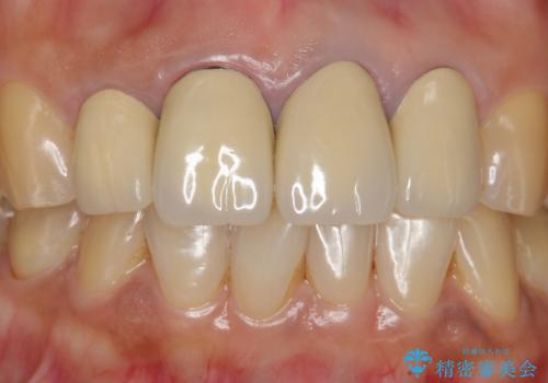 長持ちするセラミック 5年経過症例 50代女性の治療前