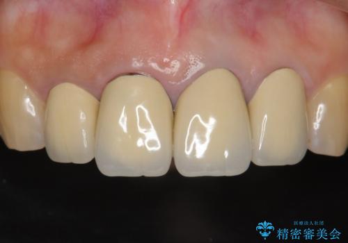 長持ちするセラミック 5年経過症例 50代女性の症例 治療前