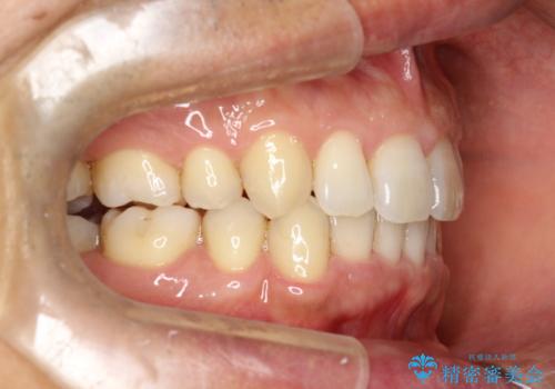 再矯正、後戻りを治したい、マウスピース矯正の治療後