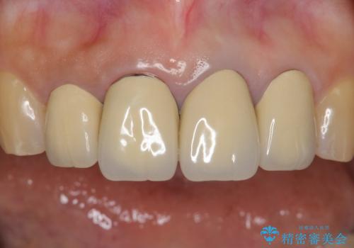 長持ちするセラミック 5年経過症例 50代女性の治療前