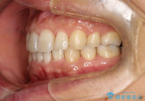再矯正、後戻りを治したい、マウスピース矯正の治療後