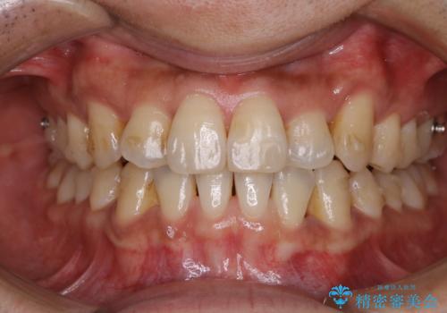 マウスピース矯正の途中にPMTCで白い歯にの症例 治療前