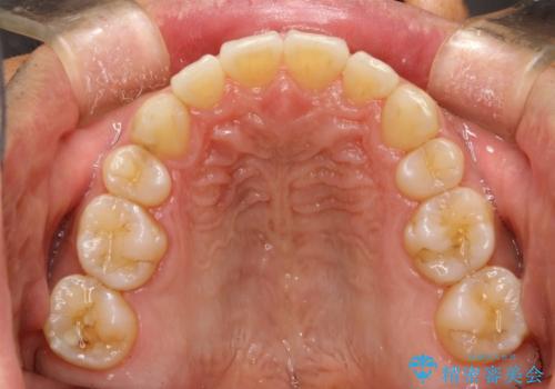 再矯正、後戻りを治したい、マウスピース矯正の治療後