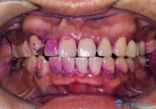 半年ぶりのメンテナンス　PMTCでピカピカな歯にの症例 治療前