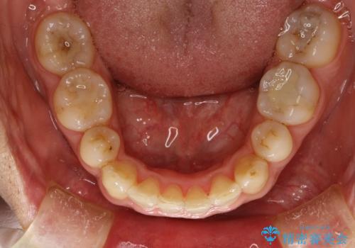 再矯正、後戻りを治したい、マウスピース矯正の治療後