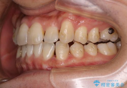 マウスピース矯正の途中にPMTCで白い歯にの治療前