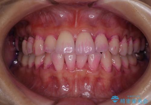 PMTCで定期的なメンテナンスをの治療前