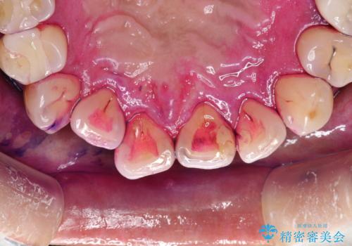 半年ぶりのメンテナンス PMTCでピカピカな歯にの治療前