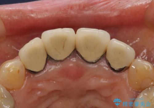 長持ちするセラミック 5年経過症例 50代女性の治療前