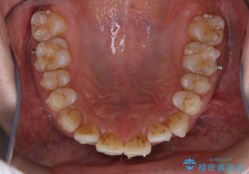 マウスピース矯正の途中にPMTCで白い歯にの治療前