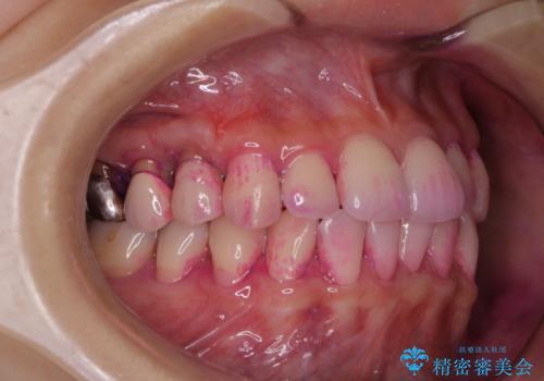 PMTCで定期的なメンテナンスをの治療前