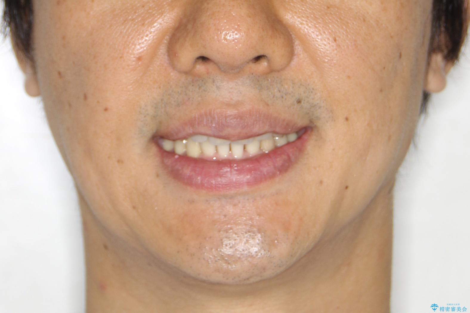 再矯正、後戻りを治したい、マウスピース矯正の治療後(顔貌)