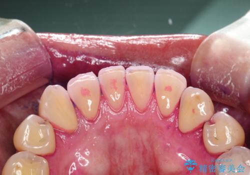 半年ぶりのメンテナンス PMTCでピカピカな歯にの治療前