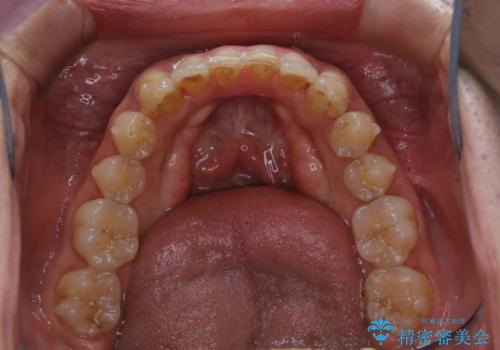 マウスピース矯正の途中にPMTCで白い歯にの治療前