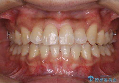 マウスピース矯正の途中にPMTCで白い歯にの症例 治療後