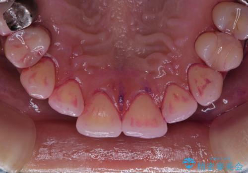 PMTCで定期的なメンテナンスをの治療前