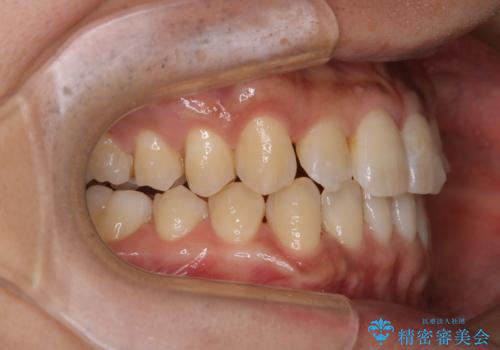 マウスピース矯正の途中にPMTCで白い歯にの治療後