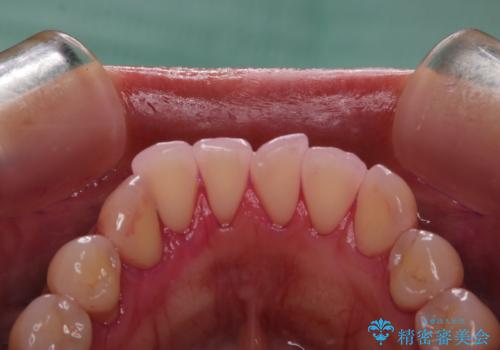 PMTCで定期的なメンテナンスをの治療前