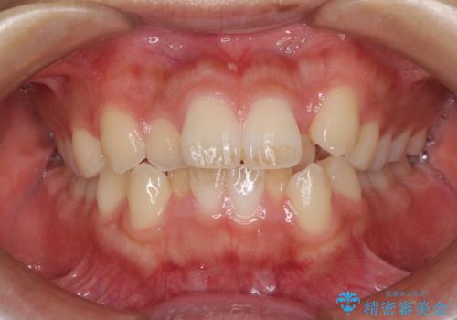 気になる八重歯を治したい 目立たないワイヤーでの抜歯矯正の治療前