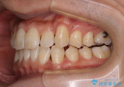 マウスピース矯正の途中にPMTCで白い歯にの治療後