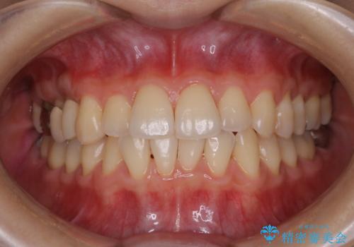 PMTCで定期的なメンテナンスをの治療後