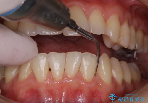 PMTCで定期的なメンテナンスをの治療中