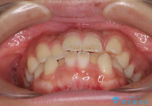 気になる八重歯を治したい 目立たないワイヤーでの抜歯矯正の治療前