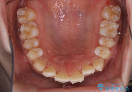 マウスピース矯正の途中にPMTCで白い歯にの治療後