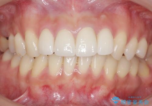 前歯をきれいにしたい 20代女性の治療後