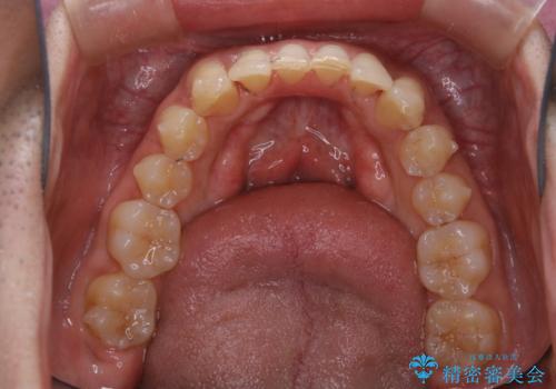 マウスピース矯正の途中にPMTCで白い歯にの治療後