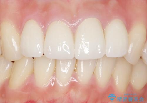 前歯をきれいにしたい 20代女性の治療後