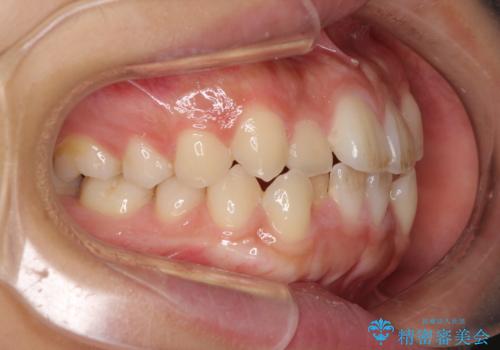 気になる八重歯を治したい　目立たないワイヤーでの抜歯矯正の治療前
