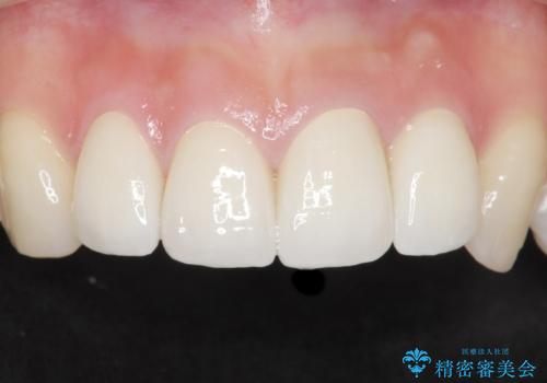前歯をきれいにしたい 20代女性の症例 治療後
